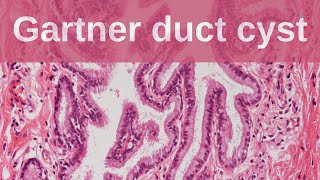 Gartner Duct Cyst  Pathology mini tutorial [upl. by Divadleahcim1]