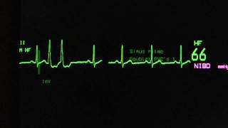 sinus rhythm with ventricular extrasystoles on an ECG monitor [upl. by Winser308]