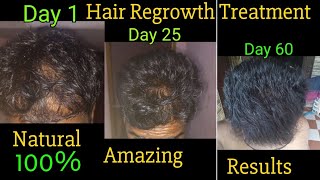 Amazing result hair regrowth new natural treatment [upl. by Bovill]