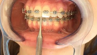 Detallaje amp Finalización en Ortodoncia [upl. by Teiv]
