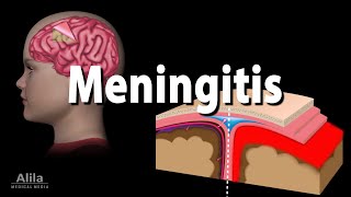 Meningitis Pathology Causes Symptoms Diagnosis and Treatment Animation [upl. by Colson]