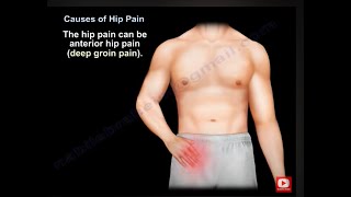 Hip pain causes symptoms  diagnosis and treatment What causes hip pain and how do you treat it [upl. by Trofmoc]