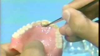 Replacing a Broken Complete Denture Tooth [upl. by Llehcear]