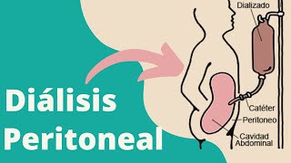 ¿Qué es la diálisis peritoneal [upl. by Ned]