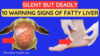 Silent but Deadly 10 Warning Signs of Fatty Liver Disease You Never Saw Coming [upl. by Iuqcaj805]