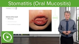 Stomatitis Oral Mucositis – Pediatric Infectious Diseases  Lecturio [upl. by Gwenneth215]