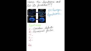 Identify The Syndrome and List the Features Syndromes MedicalMnemonics [upl. by Noxas]