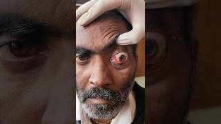 Left Eye Proptosis with No Vision Invasive Fungal  Orbital Apex Syndrome  Orbital PseudoTumour [upl. by Harat]