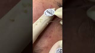 Removal acne [upl. by Lleroj]