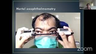 PG Orientation  Exophthalmometry  Dr Ann J K [upl. by Alleunam175]