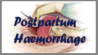 Post Partum Haemorrhage PPH  Definition Risk factors and blood volume estimation [upl. by Garate]