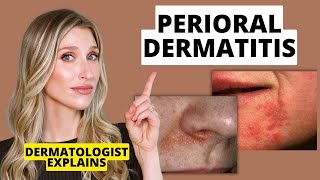 Dermatologist Explains Perioral Dermatitis What it Looks Like Causes amp Treatments  Dr Sam Ellis [upl. by Idou459]