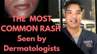 How to treat Perioral Dermatitis Dermatologist Explains [upl. by Notyad]