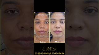 Skin Lightening Treatment Transformation ✨💫 [upl. by Hahnert]