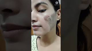 TCA Peel Remove 5th Day Chemical peel remove [upl. by Darej378]