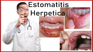 Estomatitis Herpetica y Herpes Simple  Etiologia Signos SintomasTratamiento Diagnostico VSH1 [upl. by Kingdon]