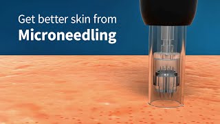 How Microneedling Improves Skin Firmness and Complexion Collagen Induction Therapy [upl. by Liew]