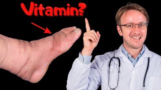 DAS WICHTIGSTE VITAMIN zur BEHEBUNG von Schwellungen an HÄNDEN BEINEN FÜSSEN [upl. by Nylassej695]