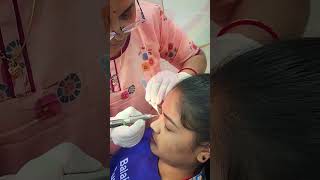 Birth mole removal by laser  DrSanjeeb Rout drsanjeebrout mole laser [upl. by Aitital]