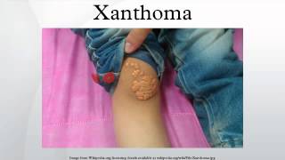 Xanthoma [upl. by Boleslaw]