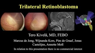 Retinoblastoma Trilateral Retinoblastoma  Dr Tero Kivela [upl. by Ardnaxela263]