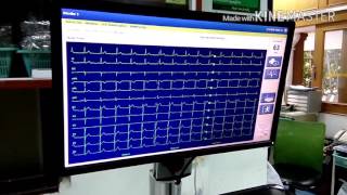 วีธีใช้12lead ECG system Mortara RScribe5 [upl. by Atnim612]