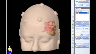 Removal of Brain Tumor Meningioma brain surgery [upl. by Japha]