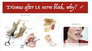 Trismus after Inferior Alveolar Nerve Block 💉 Why 🧐  Part 1 [upl. by Maillij761]