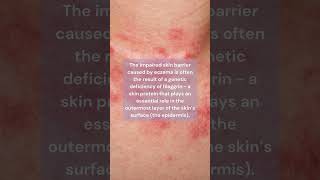 What is Eczema Atopic Dermatitis  Skin Type Solutions [upl. by Yrret]