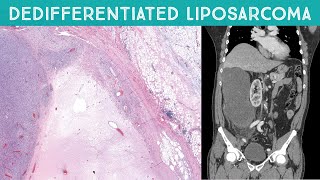 Dedifferentiated Liposarcoma huge retroperitoneal mass near kidney Oregon Case 12 [upl. by Eleanor]