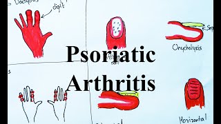 Psoriatic Arthritis Pathogenesis Clinical features and Management Visual learning [upl. by Eeliram427]