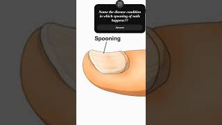 Spooning of nails  medical disease aiims norcetaiims delhishortsviralvideo [upl. by Aihtak]