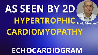 Full Insight into 2D Echo Aspect of Hypertrophic Cardiomyopathy [upl. by Pietrek100]