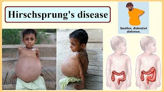 Hirschsprungs disease [upl. by Russ466]