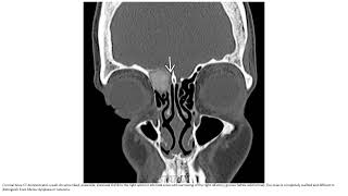 Sinonasal Ossifying Fibroma Imaging [upl. by Ijuy288]