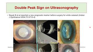 Perioperative Assessment of Intumescent Cataract How to Prevent Argentinian Flag Sign [upl. by Cochran521]