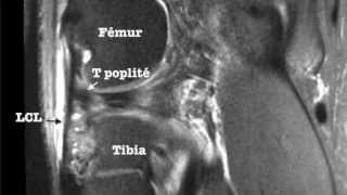 Coin postérolatéral du Genou et IRM [upl. by Darcey]