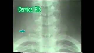 1022 Cervical Rib  Xray Reading  Dr Vaidya [upl. by Sirroned]