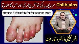 Chilblains Causes Symptoms and Homeopathic Treatments by Dr Waqar Bhutta [upl. by Melantha]