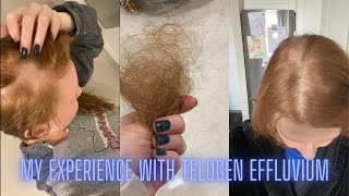 My Experience with Telogen Effluvium [upl. by Eniamrehs]