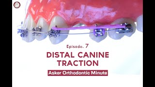 Distal Canine Traction Asker Orthodontic Minute Episode 7 [upl. by Snider]