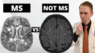 MS MRI Lesions VS quotBenignquot White Matter Lesions Explained by Neurologist [upl. by Lauer744]