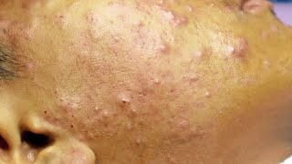 Extraction boutons et acné kystique cystic acne sur le visage [upl. by Weywadt]