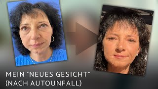 Patientenbericht Teil 2 New Face durch medizinische Unterspritzung  Tag 14 [upl. by Krause]