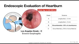 GERD  Endoscopic Evaluation  Esophageal Mucosa [upl. by Mitchiner]