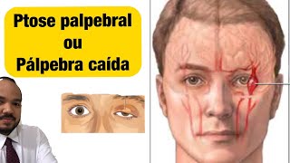 Pálpebra Caída Ptose palpebral pode ser Aneurisma Cerebral [upl. by Ause557]