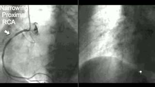 Coronary CT Angiography Cath [upl. by Notselrahc]