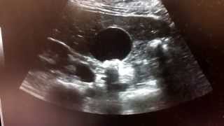 Gallstones in ultrasound [upl. by Annayehc]