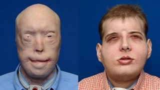 Volunteer Firefighter Receives Most Extensive Face Transplant In History [upl. by Elleira857]