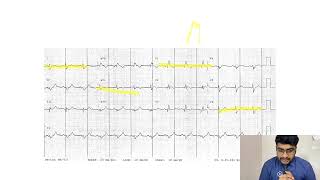 MASTERING ECGLESSON15 RIGHT BUNDLE BRANCH BLOCK RBBB [upl. by Dickens]